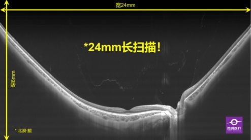 圖湃醫療亮相2021中國眼底病論壇 24mm血流成像技術引領眼底診斷新高度